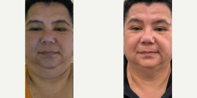 CoolSculpting before and after photo