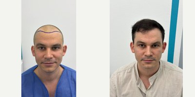 Hair Transplant before and after photo