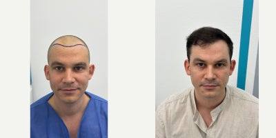 Hair Transplant before and after photo