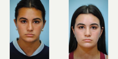 Rhinoplasty before and after photo