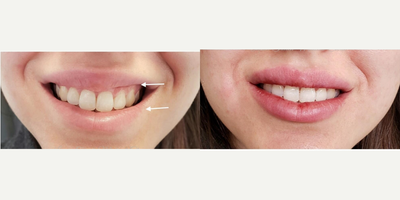 Botox for Gummy Smile before and after photo