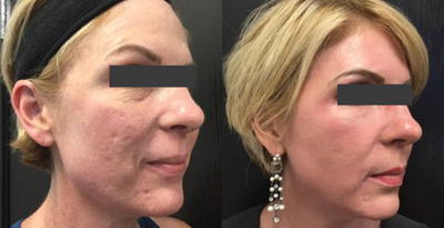 CO2 Laser before and after photo