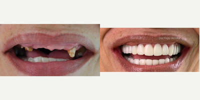 Dental Bridge before and after photo