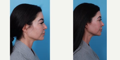 Facial Fat Transfer before and after photo