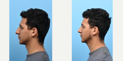 Rhinoplasty before and after photo