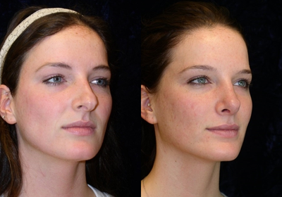 Rhinoplasty before and after photo