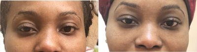 Belotero before and after photo