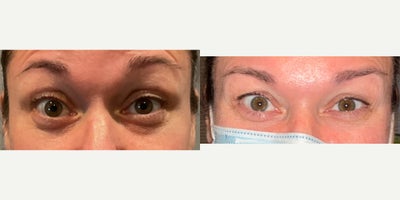 Botox before and after photo