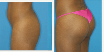 Brazilian Butt Lift before and after photo