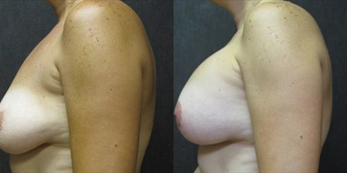 Breast Augmentation before and after photo