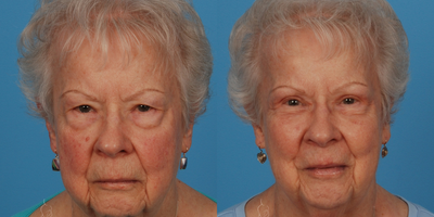 Eyelid Surgery before and after photo