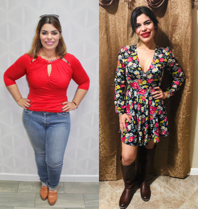 Gastric Bypass before and after photo