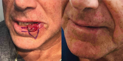 Mohs Surgery before and after photo