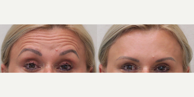 Botox before and after photo