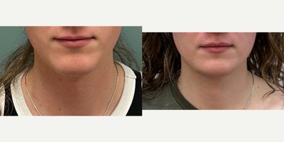 Genioplasty before and after photo