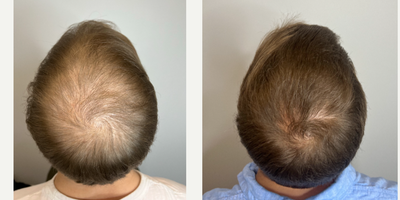 PRP for Hair Loss before and after photo