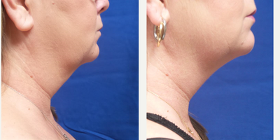 Skin Rejuvenation before and after photo