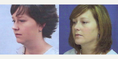 Chin Implant before and after photo