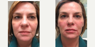 Dermal Fillers before and after photo
