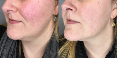 Laser Resurfacing before and after photo
