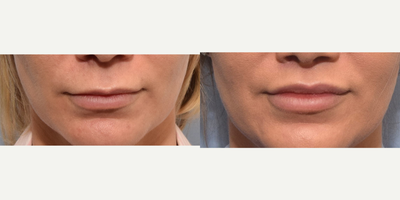 Lip Lift before and after photo