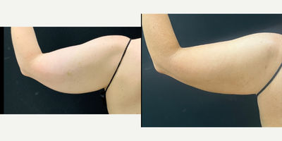 BodyTite before and after photo