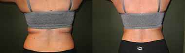 CoolSculpting before and after photo