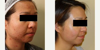 Fraxel Laser before and after photo
