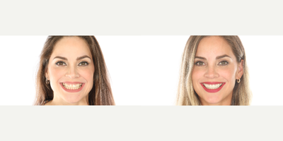 Lumineers before and after photo
