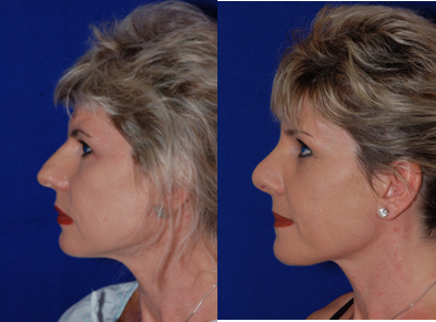 Rhinoplasty before and after photo