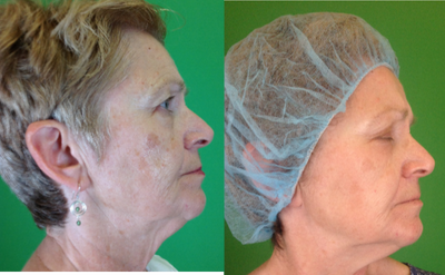 Skin Lightening before and after photo