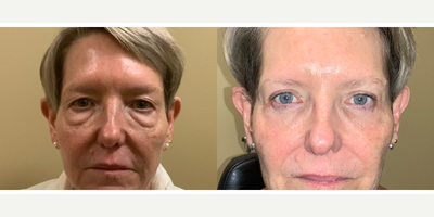 Double Eyelid Surgery before and after photo