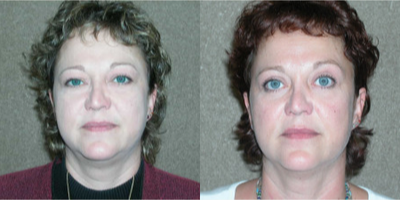 Eyelid Surgery before and after photo