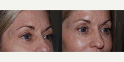 Eyelid Surgery before and after photo