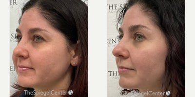Morpheus8 before and after photo