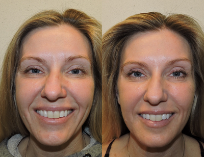 Restylane before and after photo