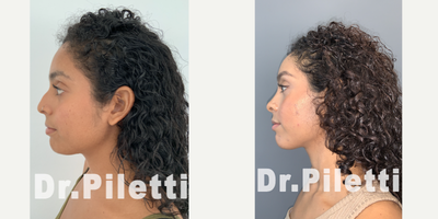 Rhinoplasty before and after photo
