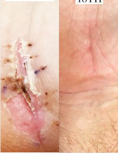 Skin Rejuvenation before and after photo