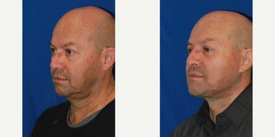 SMAS Facelift before and after photo