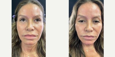 Thread Lift before and after photo