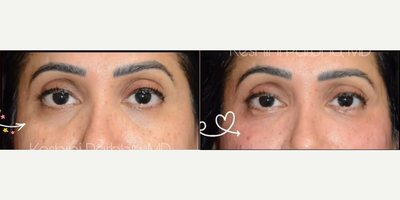Dermal Fillers before and after photo