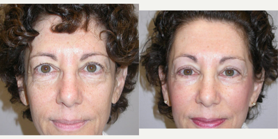 Eyelid Surgery before and after photo