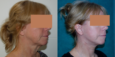 Facelift before and after photo