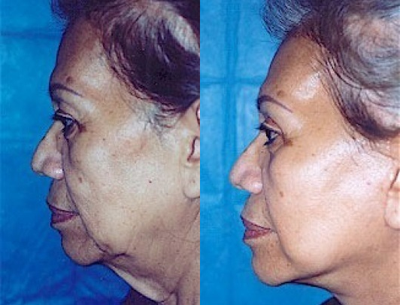 Facelift before and after photo