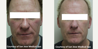 Laser Resurfacing before and after photo