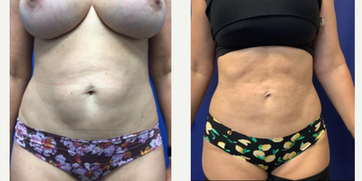 Liposuction before and after photo