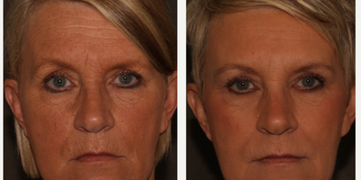 Voluma before and after photo