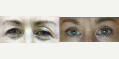 Eyelid Surgery before and after photo