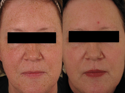 PicoSure before and after photo