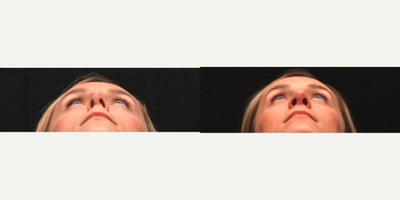 Revision Rhinoplasty before and after photo